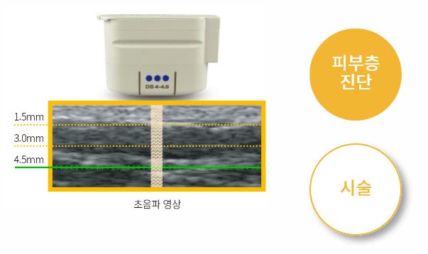 韓国整形　リフトアップ　レーザー