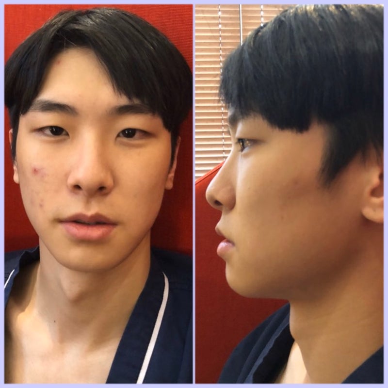 韓国美容整形 Da美容外科で鼻だけの手術でイケメン度がupのreal Story 韓国美容観光エージェンシーharu 公式blog