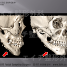 エラ手術を受ける前に考えるべき（３）：下顎削り過ぎ、下歯槽神経の損傷の記事より