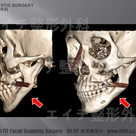 エラ手術を受ける前に考えるべき（３）：下顎削り過ぎ、下歯槽神経の損傷の記事より