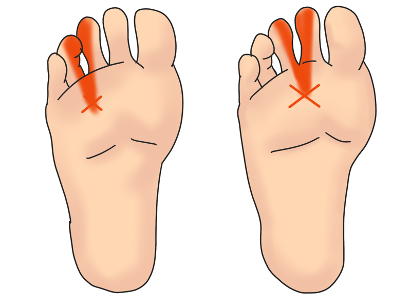 の 付け根 の 指 裏 痛み 足 足の親指の付け根が痛い原因や足の疾患と対策方法について