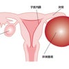 体を根本から立て直す企画、第４弾！！卵巣嚢腫編の画像