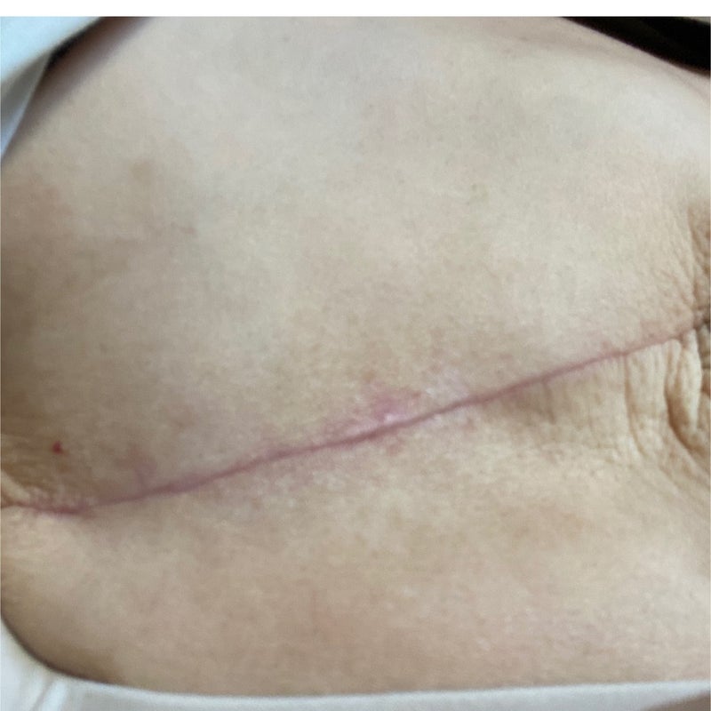 乳がん右胸全摘手術後2カ月 傷跡画像アリ 閲覧注意 乳がん1年後に45歳で出産