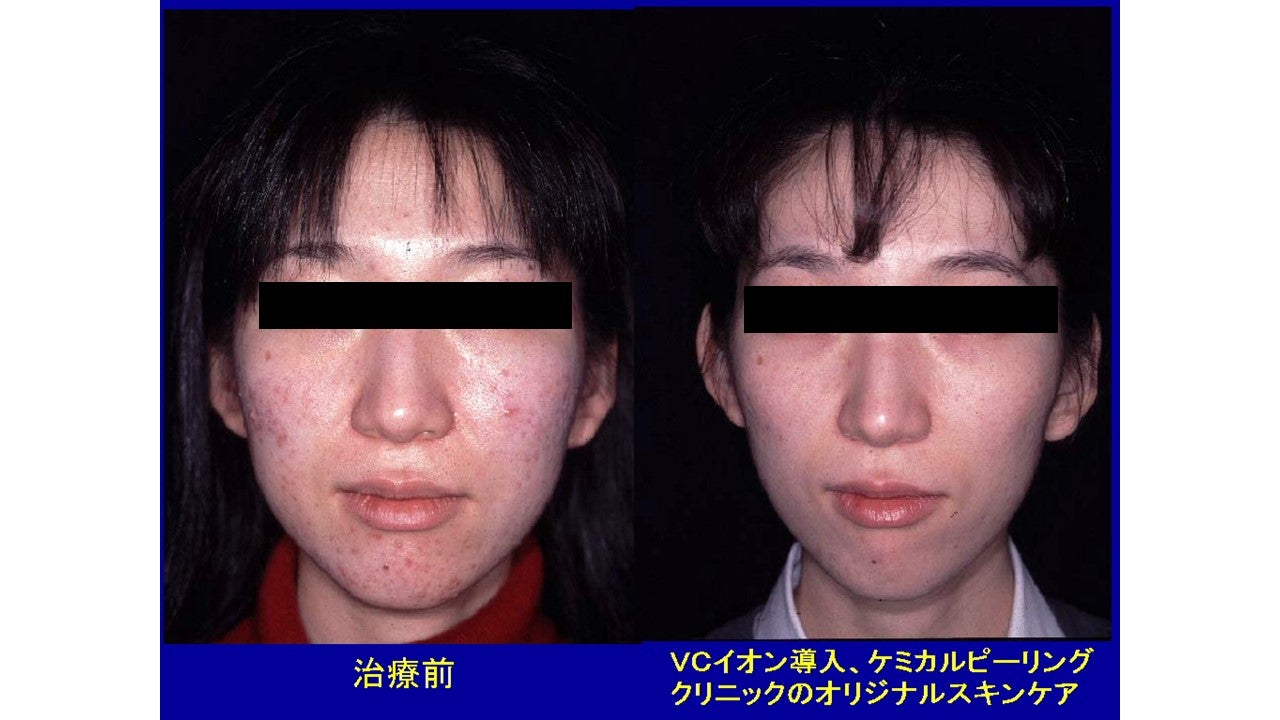 青山ヒフ科クリニックPクリームについて | 青山ヒフ科クリニック院長Dr