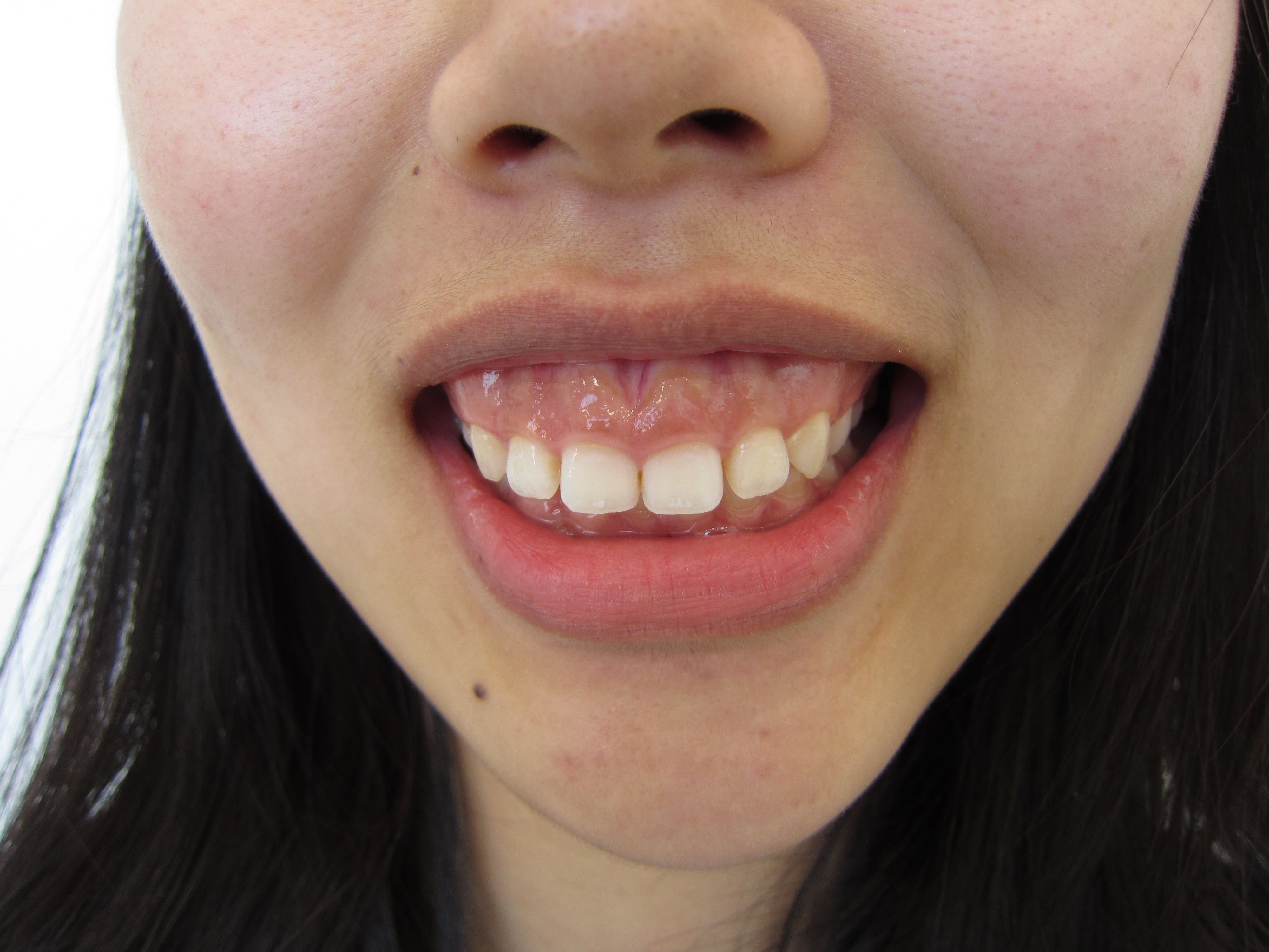歯科 ガミー スマイル 審美 笑顔の改善とガミースマイル治療