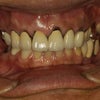 昔に入れた差し歯の歯茎が下がってしまった方！　再治療の際にご注意ください。長い歯が嫌な方へ。の画像