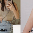 【韓国美容整形】《症例写真》＊二の腕の手術、手術前から2ヶ月後までの変化＊の記事より