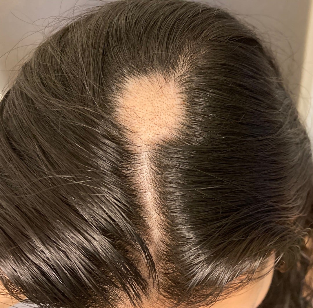 円形脱毛症⑩経過きろく