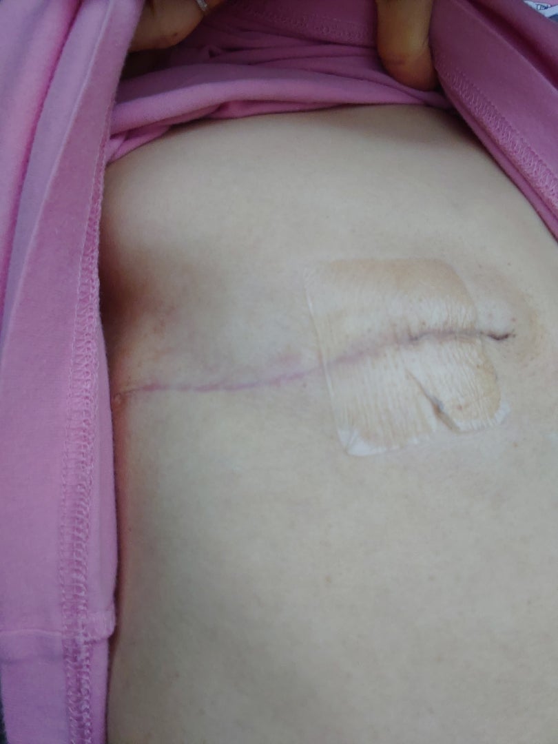 乳がん 傷痕にアトファインを貼ってみた 抗がん剤ac療法15日目 リリー保健室 34歳でステージ3a 乳がんになった保健師のブログ