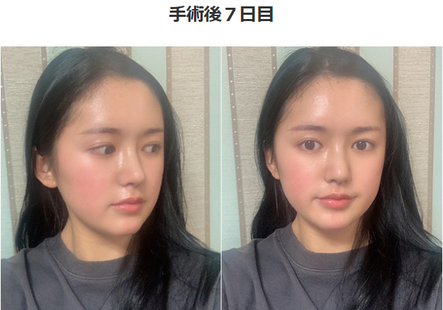 鼻再手術で鷲鼻修正 脂肪移植で女性らしいライン完成 チェヨンのリアルレビュー 韓国gng病院美容外科