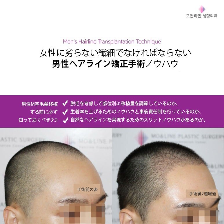 ひどいｍ字額のせいで坊主にした男性のヘアライン毛髪移植手術の結果は Molinejapanのブログ