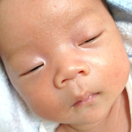 乳児湿疹と乳幼児アトピーの違いは 植物療法 乳児湿疹 子どものアトピーケア