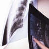 間質性肺炎の検査と診断の画像