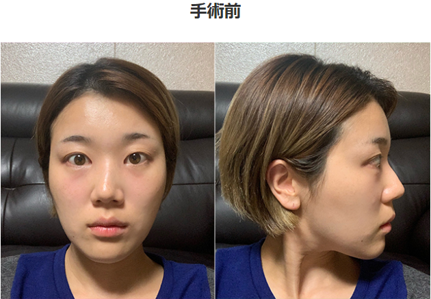 曲がってる鼻と非対称を治して美貌アプデ ウンソルさんのレビュー 韓国gng病院美容外科