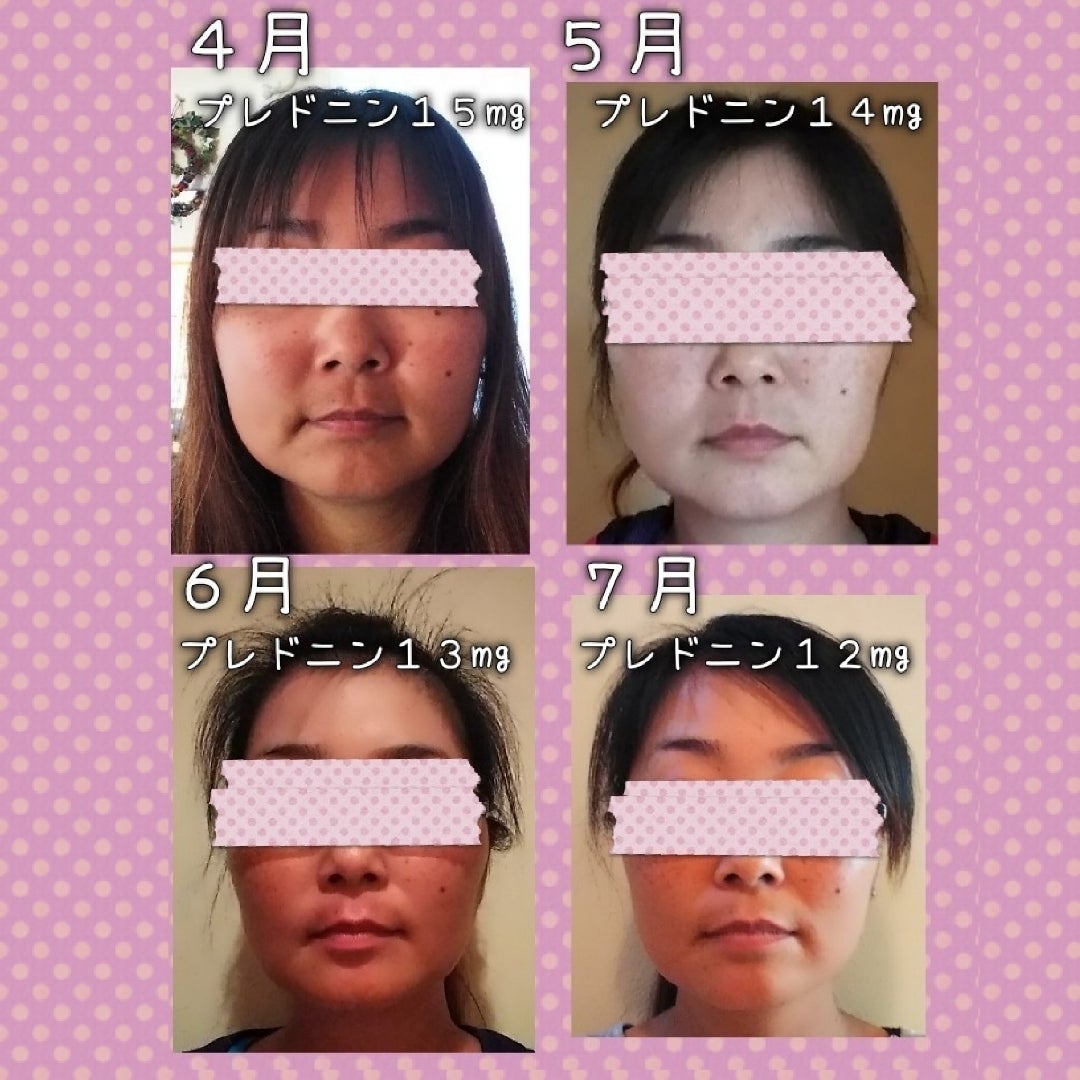 衝撃顔面比較 ムーンフェイス変化 プレドニン服用前と現在まで 19kg達成中 48kgまで公開ダイエット ダイエット Sle闘病日記
