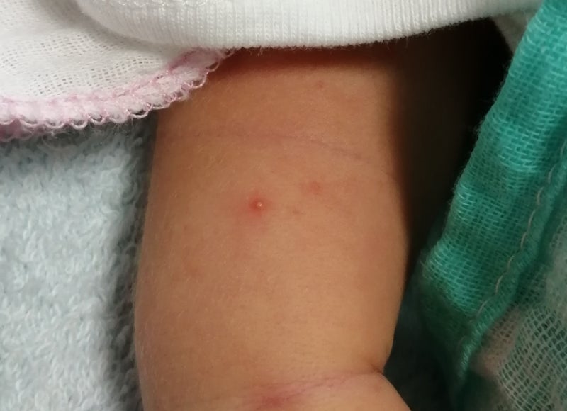 ダニ 蚊に刺された 違います 乳児湿疹です アラフォー初ママの育児日記