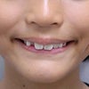 8歳　女子　上顎前突が主訴　１期＆２期治療（非抜歯）が終了いたしました。の画像