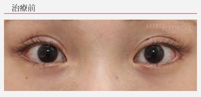 『片目の垂れ目形成術の症例解説（他院修正）』