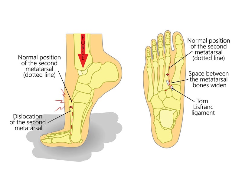 足の評価方法 リスフラン靭帯損傷 トレーナー情報発信マガジンめんてなラボ