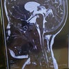 MRI結果…の画像