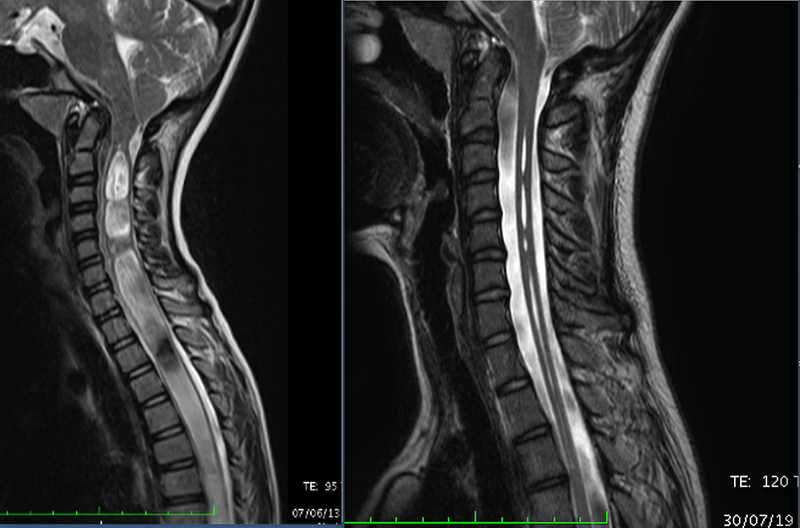 日本人患者さんの体験談リスト バルセロナキアリ奇形・脊髄空洞症・脊柱側弯症研究所のブログ