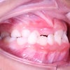 7歳　女子　受け口が主訴　チンキャップ（I期）矯正治療＆ 小臼歯４本抜歯（II期）矯正治療が終了の画像