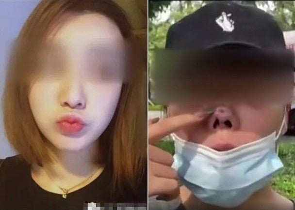 中国で美容整形失敗した女性 鼻が陥没 周来友 オフィシャルブログ