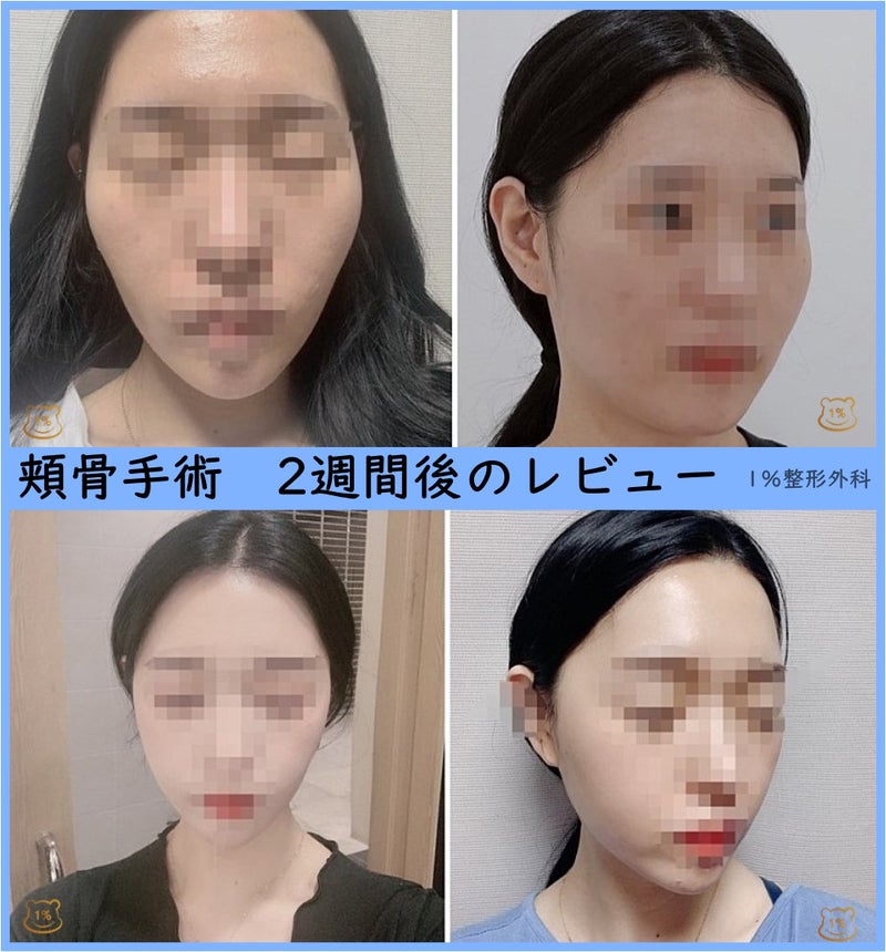 韓国頬骨縮小のレビューのまとめ 術後の自分の顔が大好きになりました 韓国1パーセント整形外科の公式ブログ 1 美容整形外科は安全で綺麗な輪郭 整形を目指します