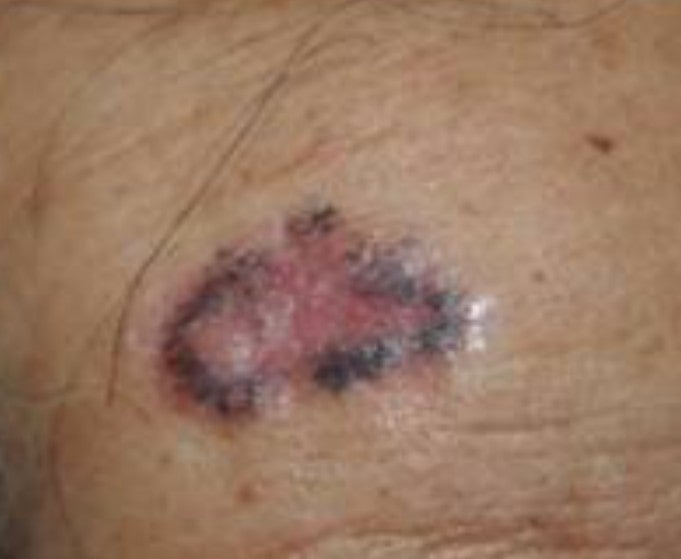 皮膚癌の概要 薬局 薬 病気のブログ