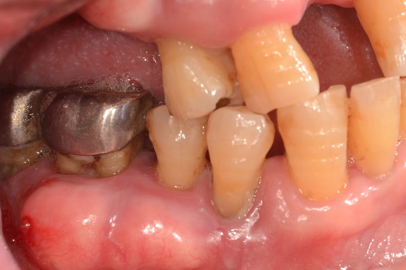 歯茎 奥歯 腫れ の