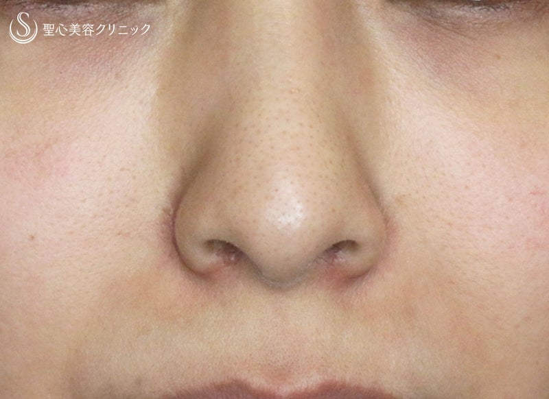 鼻の存在感を消す・+α法（1M） | 聖心美容クリニック 前多 一彦 Blog
