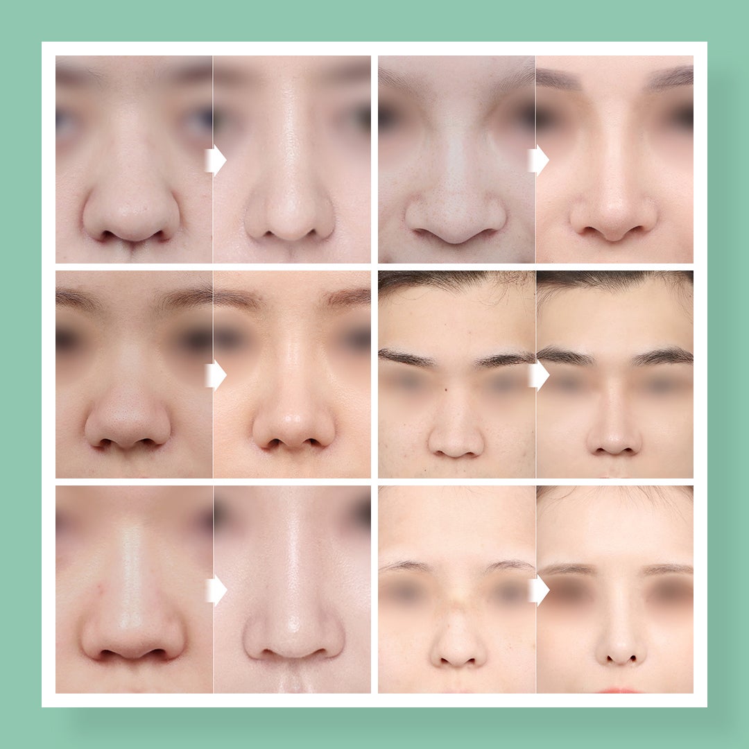 鼻中隔延長で、今流行の韓国風アップノーズに｜症例写真・ビフォーアフター｜美容整形･美容外科のTAクリニックグループ