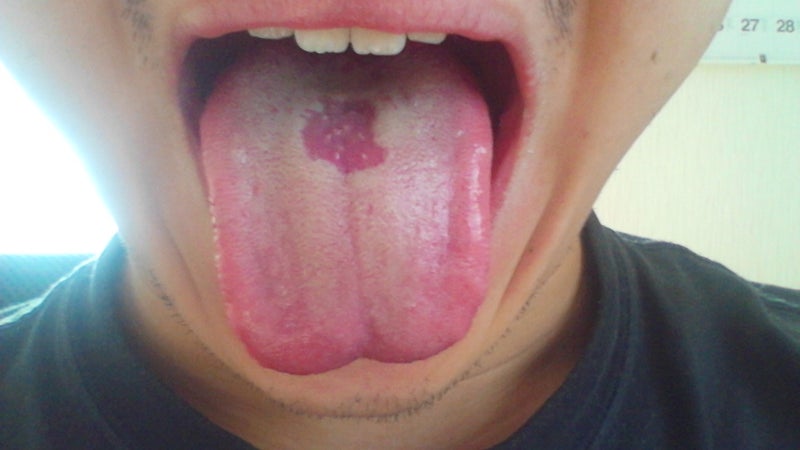 舌動脈舌背枝