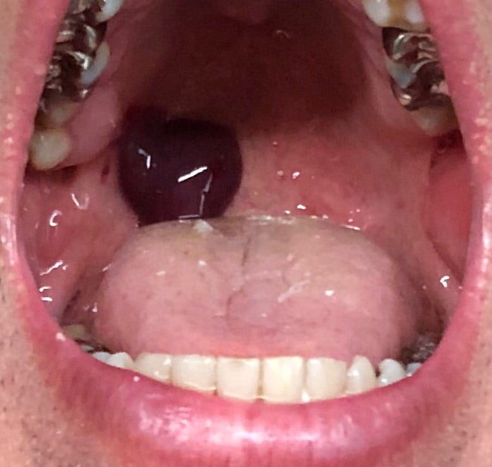 口 の 中 血豆 写真