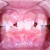 6歳　男子　受け口が主訴　チンキャップ（Ⅰ期）＆小臼歯4本抜歯（Ⅱ期）治療が終了の画像