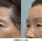 【韓国整形/韓国美容外科】効果200％！二重整形の前に必要な手術？！「額挙上術」リフティング術の記事より