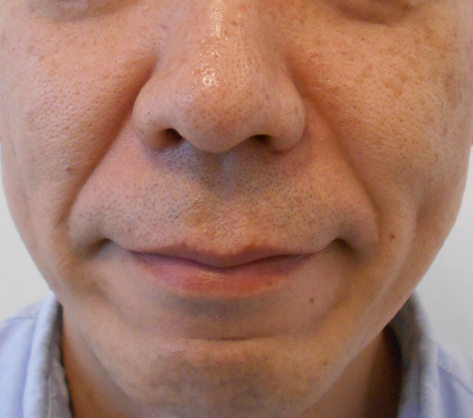 グロースファクターによるほうれい線治療 40代男性 Hiroo Skin Clinic院長ブログ
