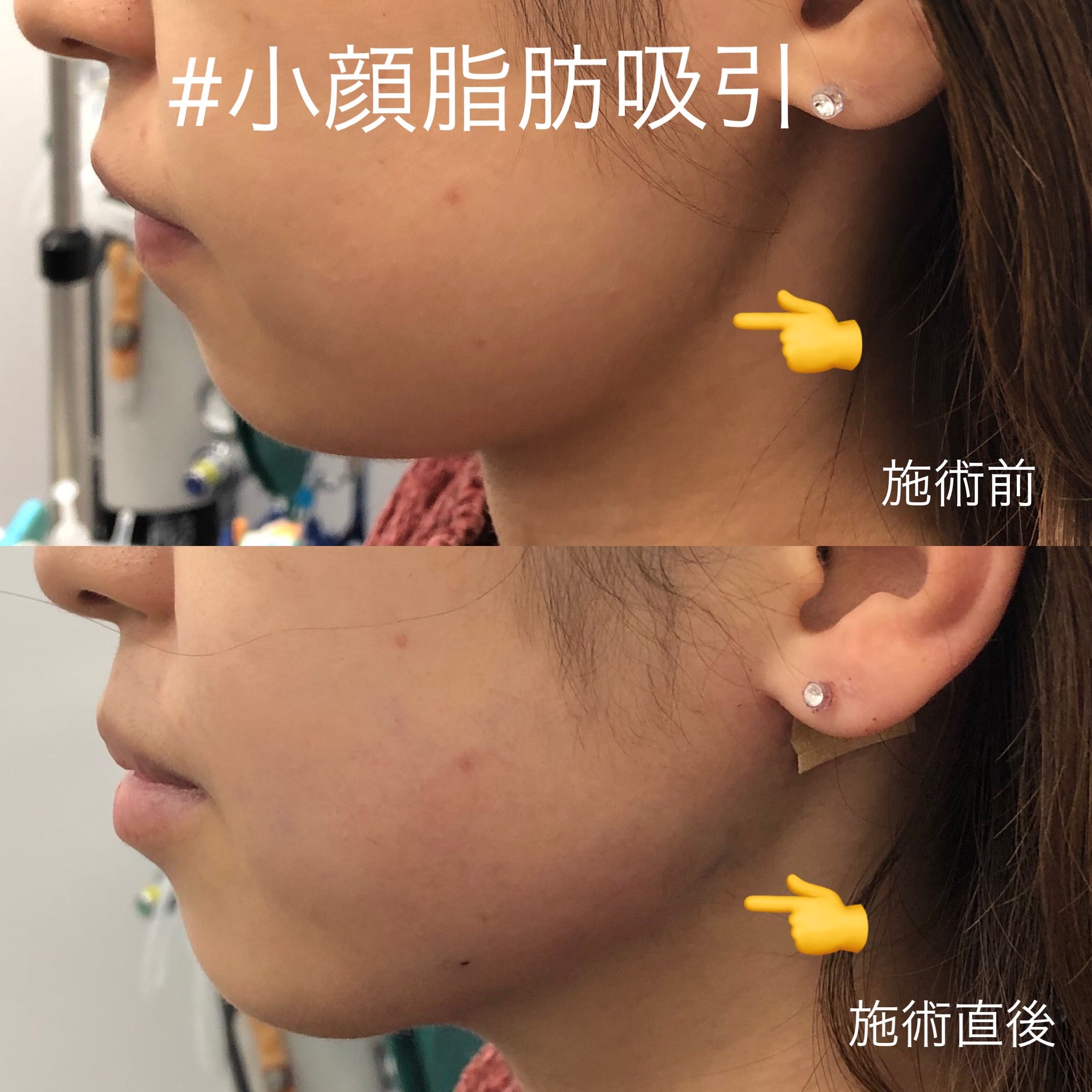 人類みな小顔 日本一腫れない 脂肪吸引 画像あり 小顔先生 美容整形外科 医師 和倉隆造 人類みな小顔 日本一腫れない 脂肪吸引 画像あり 小顔先生 美容整形外科 医師 和倉隆造