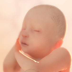 双子妊娠〜絨毛膜下血腫〜の画像