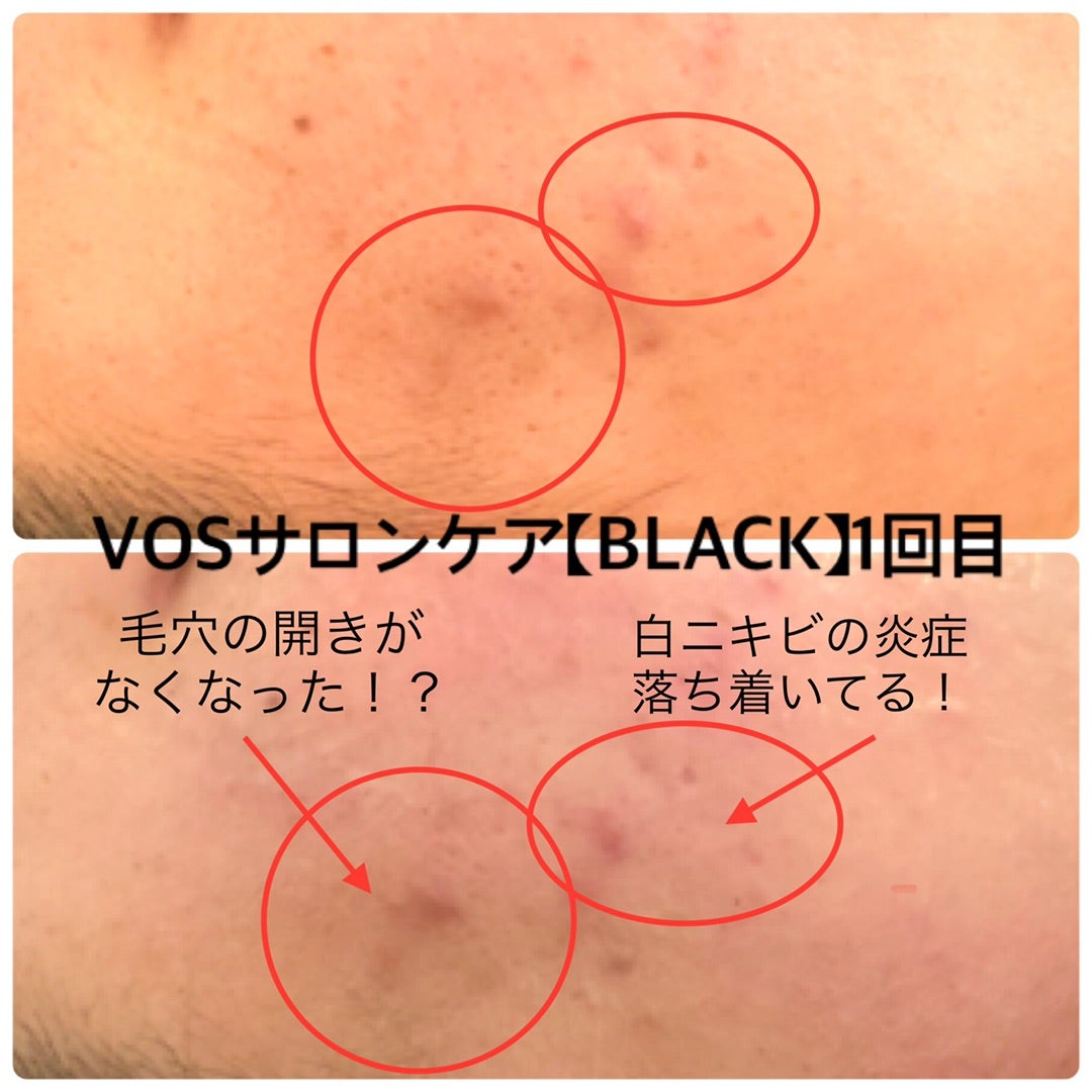 VOSサロンケア【BLACK】ニキビが小さくなる！ | 大阪市城東区：女性の 