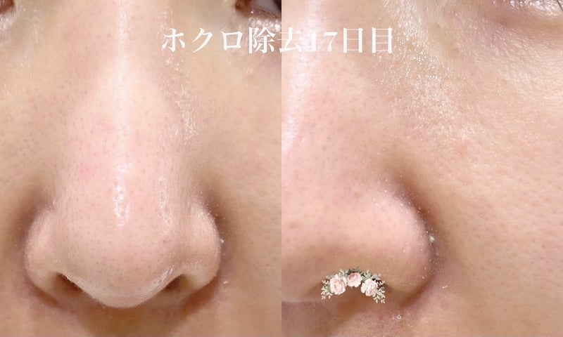 鼻の横のホクロ取り 13 25日目経過 Kopurio韓国美容ブログ