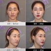 【韓国整形/韓国美容外科】両顎手術以外に長い顔を短くする方法とは？