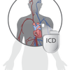 植込み型除細動器ICDって何？( Dr. Kihei Yoneyama心臓のお医者さん)の画像