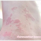 8月人気ブログランキング記事★BEST5★1位はジアミンアレルギー・身体の痒みと蕁麻疹・虫に刺さの記事より