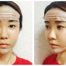 ［韓国美容整形］ラミチェ美容外科で若くなっちゃった⁈REAL STORY♡の記事より