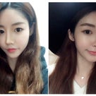［韓国美容整形］ラミチェ美容外科で若くなっちゃった⁈REAL STORY♡の記事より