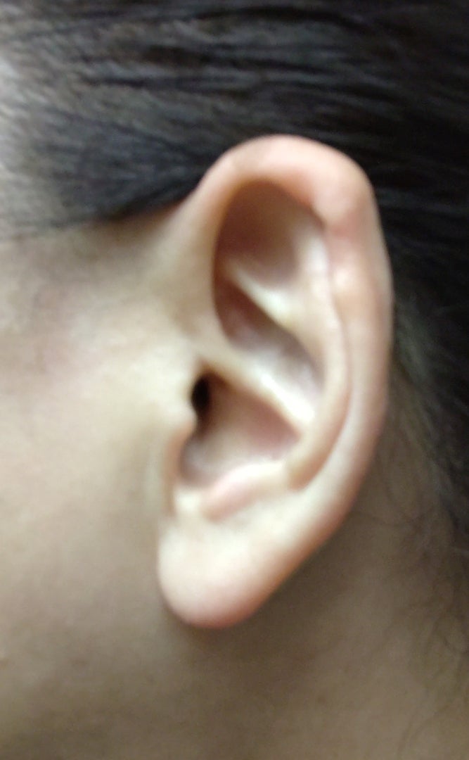 耳たぶのシワは動脈硬化の現れ Kumikoのブログ 耳たぶのシワは動脈硬化の現れ Kumikoのブログ