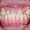 35歳　女性　主訴は下顎前突と八重歯　下顎にバイトプレート使用して非抜歯での治療が終了しました。の画像