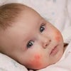 赤ちゃんの湿疹を引き起こす要因は5つ、無頓着な親は要注意の画像