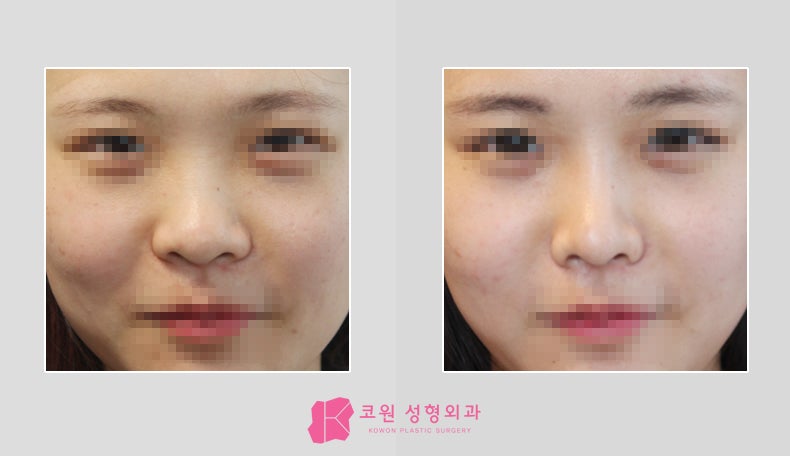 症例写真紹介 団子鼻矯正の症例 韓国の鼻手術専門 コウォン整形外科